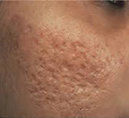 acne scarring