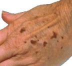 Age spots on hand